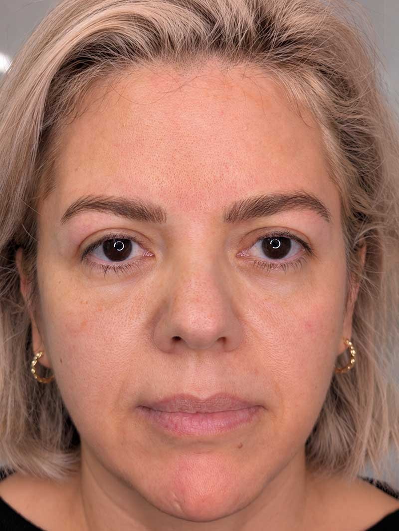 Nano-Brows-before-1